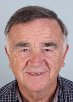 After Hair Transplant&nbsp;Front
